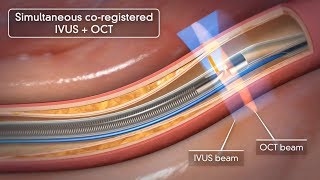 Novasight Hybrid System  Conavi Medical [upl. by Malloy467]