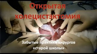 Открытая холецистэктомия техника операции [upl. by Schonfeld]