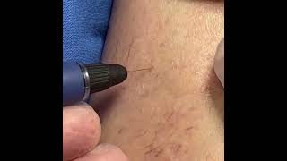 Spider vein removal [upl. by Milena524]