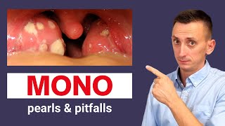 Infectious Mononucleosis Mono Symptoms Diagnosis and Treatment [upl. by Glory]