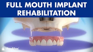 Full mouth rehabilitation with 6 dental implants and fixed denture © [upl. by Airamzul]