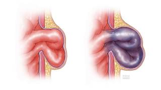 Is Hernia curable without Surgery [upl. by Nogam]