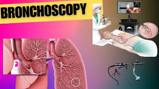 Understanding Bronchoscopy and its benefits  Bronchoscopy Procedure [upl. by Torres]