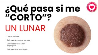 ¿Los Lunares son Peligrosos  ¿Qué Pasa si te Cortas un Lunar [upl. by Scrivings]