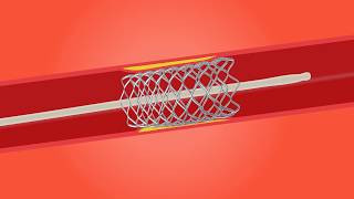 Stent procedure [upl. by Annairam]