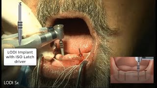 Anatotemp  Maxillary Lateral  Mandibular Incisor [upl. by Maxwell]