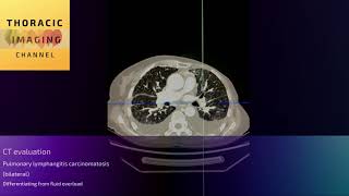 CT assessment  evaluating pulmonary lymphangitis carcinomatosis [upl. by Yerahcaz886]