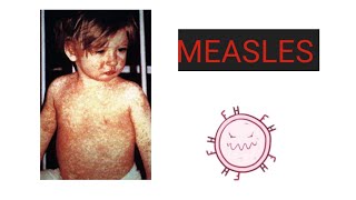 MEASLES Causes Pathology Symptoms Diagnosis Treatment Vaccination Care  What is Measles [upl. by Drice]