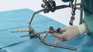 Retractor for ventral access  Spine Surgery [upl. by Eirallam]