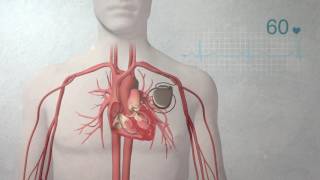 What is a pacemaker [upl. by Enigroeg]