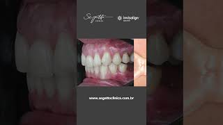 Caso de retratamento ortodôntico com Invisalign® [upl. by Arissa]