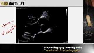 Lecture 3  Transthoracic Echocardiography Part 2 [upl. by Pournaras]