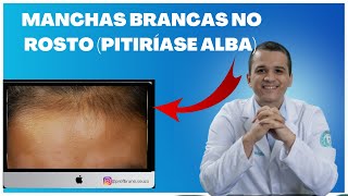 Como tratar pitiríase alba manchas brancas no rosto [upl. by Austin239]