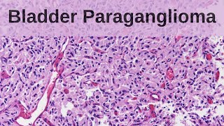 What are Granulomas  Pathology mini tutorial [upl. by Rawdin]