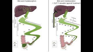 Bile acid malabsorption or bile acid diarrhea  Definition Causes Symptoms Diagnosis Treatment [upl. by Martinson]