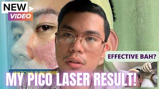 My Pico Laser Treatment Result  Before and After [upl. by Ardnassela495]