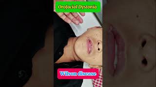 Orofacial dyskinesia  oromandibular dystonia  wilson disease [upl. by Yramliw]