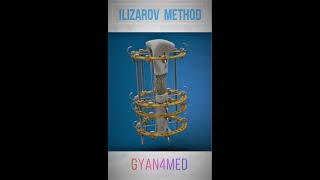 ILIZAROV method  Complete Surgical Demonstration [upl. by Osicnarf]