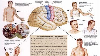 Como identificar una verdadera crisis de epilepsia [upl. by Wane]