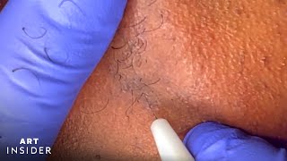 Electrolysis Permanently Removes Body Hair [upl. by Karlan]