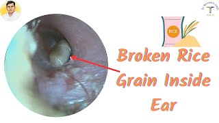 Very Difficult to Remove Swollen Rice 🌾 🌾🌾🌾Grain Inside Ear👂👂👂👂 [upl. by Ralyt364]