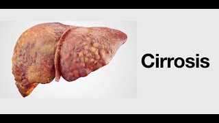 Cirrosis  Causas Síntomas Pronóstico y Tratamiento [upl. by Idihsar]