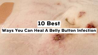 10 Best Ways You Can Heal A Belly Button Infection [upl. by Silra]