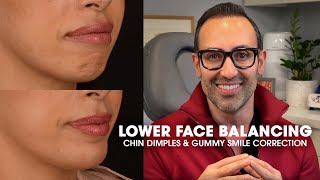 NonSurgical Lower Face Balancing  Dr Kian [upl. by Eniger]