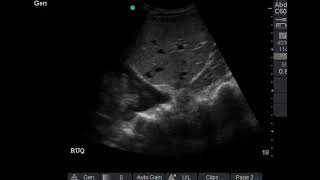 Pleural effusion with lung collapse amp spine sign in right hemithorax [upl. by Abeh]