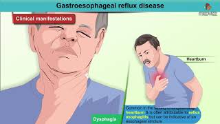 Gastroesophageal reflux disease Animation  GERD  Etiology  Diagnosis  Pathology  Treatment [upl. by Mayer]