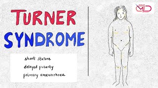 Turner Syndrome  Genetics Pathology Presentation  Dr Shonali Chandra [upl. by Acirfa]