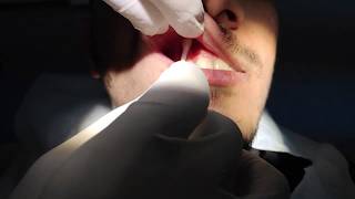 Maxillary Infiltration Anesthesia Technique [upl. by Tella258]