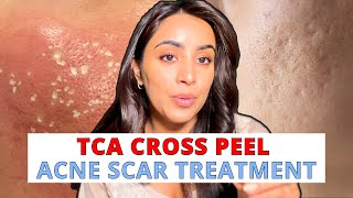 Synergistic Acne Scar Treatment  Subcision TCA CROSS RF Fractional PRP Fillers [upl. by Acisej879]