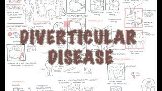 Diverticular Disease diverticulitis  Overview [upl. by Sacha]