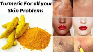 Top 3 Ways To Use Turmeric For Skin Pigmentation Skin Whitening amp Skin Tags  Home Remedies [upl. by Tloc109]