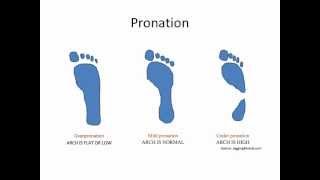 What Is Overpronation [upl. by Ynehpets]