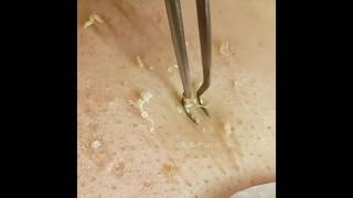 The Best Blackhead Tweezers [upl. by Asimaj799]