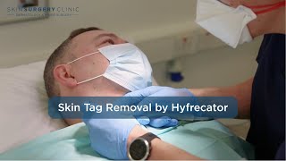 Skin Tag Removal with Dr Andrew Smith [upl. by Ryann855]