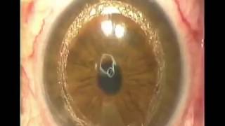 Keratoconus Correction INTACS amp KERATOCONUS TitratedINTACS surgery straight to 2020 [upl. by Burkhardt]