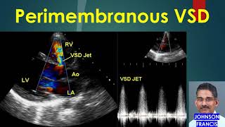 Perimembranous VSD [upl. by Ornie]