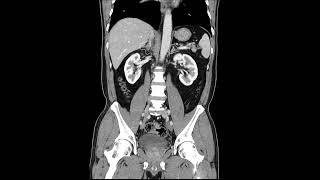 Functional Adrenal Tumors An Update in Diagnosis and Treatment [upl. by Ermentrude]