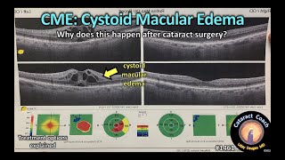 CataractCoach 1461 cystoid macular edema CME after cataract surgery [upl. by Clovis78]