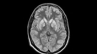 Case discussion Hypoxic Ischaemic Encephalopathy HIE [upl. by Pool]