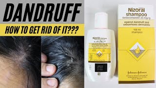 Dandruff  Flaky Itchy Scalp  Nizoral Shampoo Review [upl. by Ardnyk]