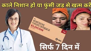 elocon ointment use in hindi mometasone ointment [upl. by Cunningham]