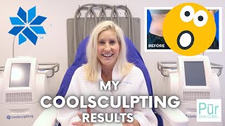 My COOLSCULPTING Results  CoolSculpting Before amp After  Does It Work  Pūr Skin Clinic [upl. by Asus]