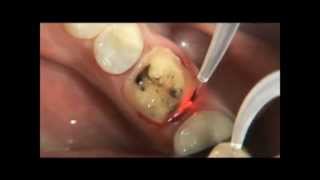 PHILIPS LASERS Eviction gingivale 3wmv [upl. by Courtland227]