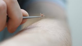 How to properly remove a tick [upl. by Desberg]