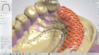 3Shape Dental System Removable Partial Framework Design and SLM Production with Tim Bertram [upl. by Mikel]