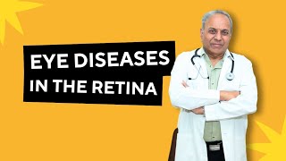 Retinal diseases amp Problems  Diseases caused in the Retina  Nonsurgical vision treatments [upl. by Fabiano691]